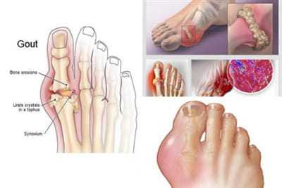 Chia sẻ một số điều cần biết về bệnh gút