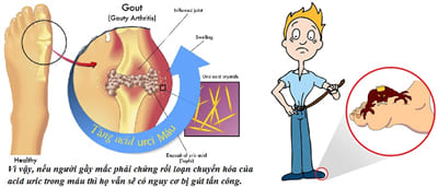 Tăng Acid uric trong máu có phải bị Gout (gút)?