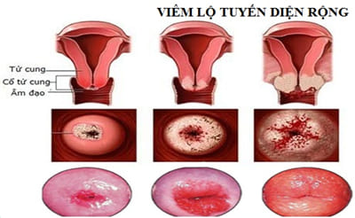 Cách kiểm tra ung thư cổ tử cung